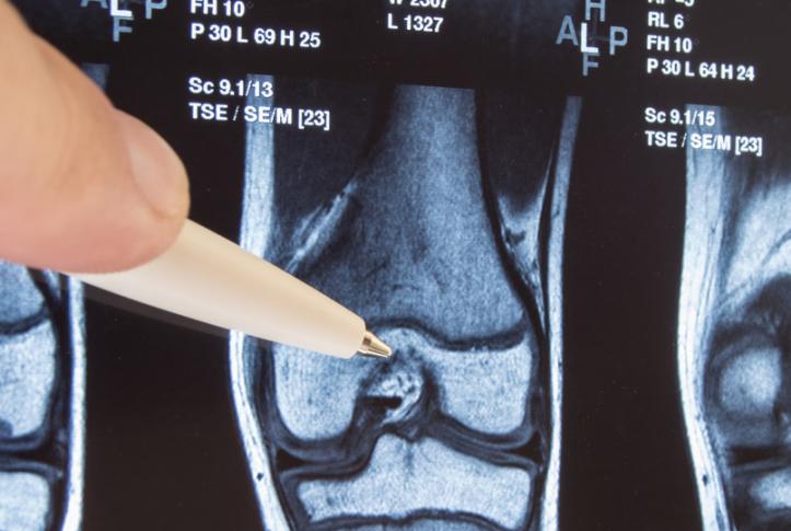 Lower extremity joint replacement